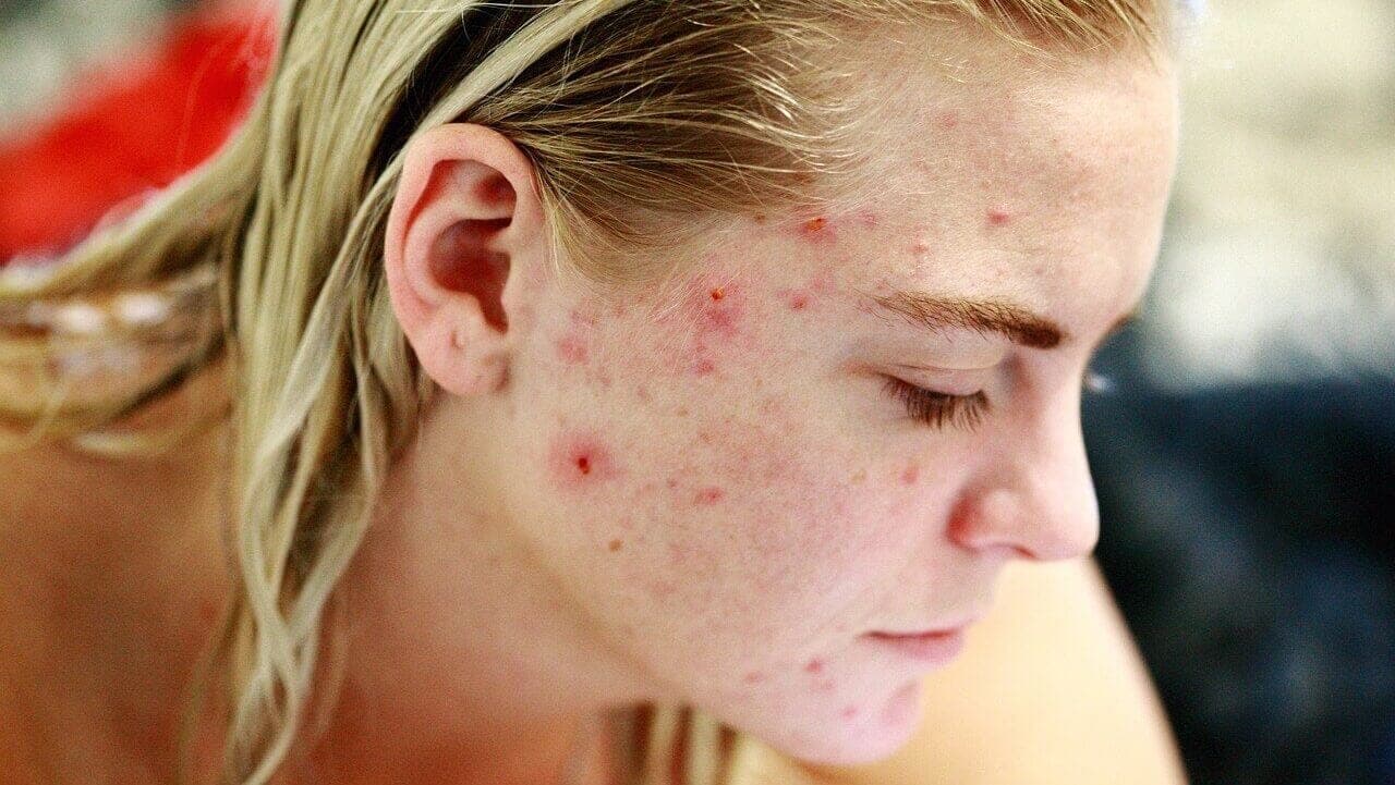 Bible du Traitement de l’acné : solutions efficaces pour votre peau et vos boutons